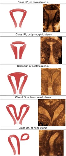 Figure 1 Classification of main uterine anomalies.