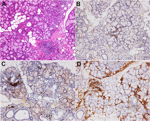 Figure 2 (A) Focal periductal localized lymphocytic infiltrates in exocrine glandular tissue along with otherwise intact acinar. Interstitial infiltration and focal aggregation of plasma cells were seen (3 focus, ≥ 50 cells/focus), (HE×100). (B) CD3 (+ focally and sparsely, IHC×100). (C) CD20 (+ focally and sparsely, IHC×100). (D) CD38 (+, IHC×100).