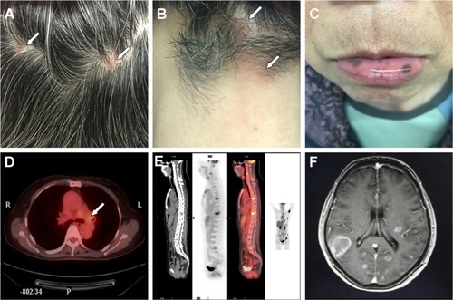 Figure 1 Imaging of scalp nodules, lung cancer, and its metastatic lesions.