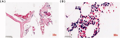 Figure 3. Bone marrow biopsy analysis. (A) Lymphocytes and plasma cells are scattered (×10). (B) There was no increase or aggregation of primitive/naive cells, lymphocytes, and plasma cells (×80).