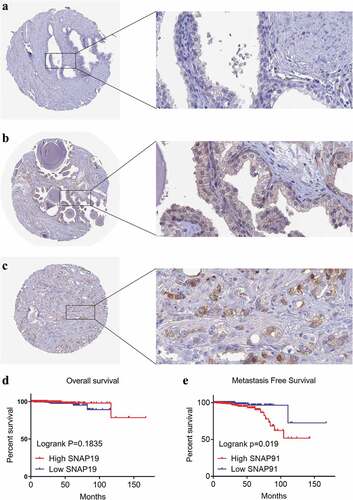 Figure 9. HPA immunohistochemistry and Kaplan-Meier analysis of SNAP91. (a) The expression level of SNAP91 protein was not detected in normal prostate tissue (Antibody HPA029633, Male, age 60). (b) The expression level of SNAP91 protein was not detected in normal prostate tissue (Antibody HPA029632, Male, Age 48). (c) The expression level of SNAP91 protein was moderate in prostate adenocarcinoma (Antibody HPA029633, Male, age 79). (d) Overall survival of patients with different SNAP91 expression in PCa. (e) Metastasis-free survival rate of patients with different SNAP91 expression in PCa. HPA: Human Protein Atlas; SNAP91: synaptosome-associated protein 91