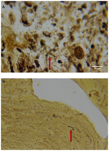 Figure 4 (A) Warthin–Starry-stained section of a Morgellons disease callus, patient 2, demonstrating a spirochete (arrow). 1000× magnification. (B) Dieterle stain, spirochete from patient 1 (arrow). 1000× magnification. (C) Dieterle stain, spirochetes from patient 2. 1000× magnification. (D) Dieterle stain, spirochetes from patient 3. 1000× magnification. (E) Dieterle stain, spirochetes from patient 4. 1000× magnification. (F) Warthin–Faulkner-stained bovine digital dermatitis section, showing numerous spirochetes among keratinocytes. 1000× magnification.