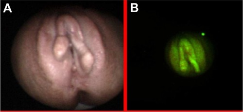 Figure 5 Lichen sclerosus in white light (A) and autofluorescence (B) imaging.