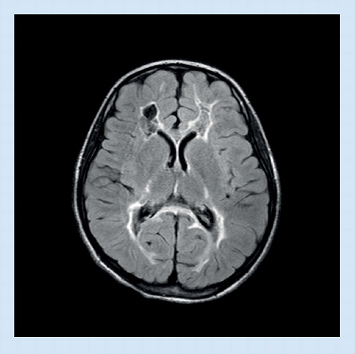 Figure 5. MRI in cystic leukodystrophy (fluid-attenuated inversion-recovery image).
