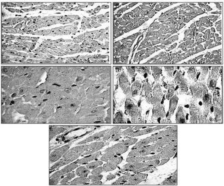 Figure 5. Representative photomicrographs of heart ventricular tissue stained for Bax protein from different experimental groups. The localization of Bax protein is indicated by purple positive immunoreactivity. (A) ISP-treated rats, showing increased expression of Bax protein; (B) healthy control rats, showing slight Bax immunoreactivity; (C) HETA-treated rats, showing less Bax expression than ISP-treated control; (D) α-tocopherol-treated rats, showing less Bax expression than ISP-treated control; (E) HETA + α-tocopherol combination, showing attenuated Bax expression compared to ISP-treated control.