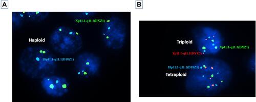 Figure 4 (A) Nuclei of multiple trophoblasts showing multiple diploid trophoblasts (two blue and two green signals) and a single haploid trophoblast (a single blue and green signal) representing a mosaic diploid-haploid embryo. (B) Nuclei of two trophoblasts showing a tetraploid trophoblast (four red, four green and four blue signals) and a triploid trophoblast (three red, three green and three blue signals).