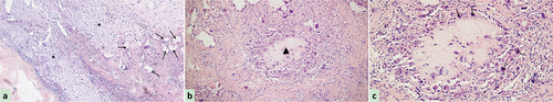 Figure 3. Morphological characteristics of preoperative biopsy using fine needle aspiration revealed through hematoxylin-eosin staining. (a) Abundant mucoid and loosely distributed spindle-shaped or stellate cells (black asterisk, original magnification × 100), and rich fibrous septal lobes in cartilage matrix (black arrow, original magnification × 100); (b) an atypical lesion of fibrous septal lobe containing circularly close-packed cells surrounding clear mucus and extracellular matrix (black triangle, original magnification × 200); (c) a large amount of mononuclear spindle-like stromal cells mixed with occasional multinucleated giant cells (black arrow, original magnification × 400).