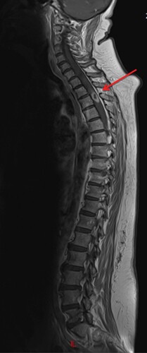 Figure 3. Patient 2. Sagittal T1-weighted MRI showing an intramedullary mass regarding T2 vertebrae (arrow).