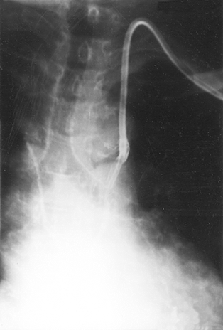 Figure 4. The pathway of the blood from the left arm (via epigastric and other veins).