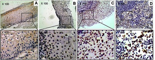 Figure 4 The marker (P53) of DNA damage response in study sample. (A) Cervicitis; (B) CIN I; (C) CIN II/III; (D) SCC. Original magnification, ×100 and ×400.