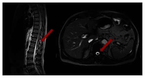 Figure 3 Magnetic resonance imaging T2 image of the lumbar spine. The right side image is the enlarged version of the left image. A high signal in the center indicates spinal cord infarction.