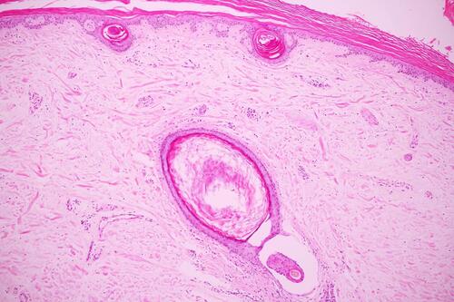 Figure 3 Histopathological examination: laminated hyperkeratosis with hypogranulosis and a dilated hair follicle.
