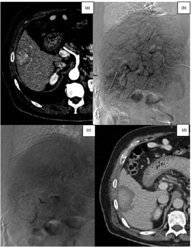 Figure 3. (a) Axial venous phase contrast-enhanced CT scan image of a 76-year-old woman, showing a gastric neuroendocrine metastasis in the V-VI hepatic segment. (b) Selective diagnostic angiography of the hepatic artery showing the tumor. (c) Post-TAE selective diagnostic angiography showing the complete devascularisation of the tumor. (d) Axial venous phase post-contrast CT-image showing the embolized tumor with a necrotic enlarged area.