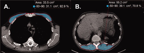 Figure 1. Representative computed tomography (CT) scans at thoracic level used to determine muscle area in chronic obstructive pulmonary disease (COPD). (A) CT image used for pectoralis muscle imaging shaded in light blue. (B) CT image for erector spinae muscle imaging shaded in light blue. Label delineates the designated Hounsfield units for skeletal muscle from –50 to 90, the percentage of skeletal muscle mass, and the CSA measured in cm2.