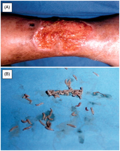 Figure 3. Cutaneous myasis caused by Chrysomya bezziana. (A) Cutaneous myiasis ulcer on right leg of patient, (B) Isolated Chrysomya bezziana larvae from ulcer of a patient. Figure adopted with publisher’s permission from Ref. Citation57.