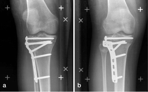 Figure 4. Radiographs of the application of RSA in vivo. Focus 1 (panel a) and focus 2 (panel b).