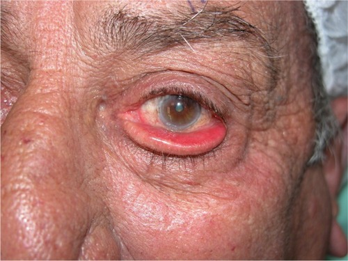 Figure 2 Severe left lower lid ectropion in a 78-year-old patient treated with Xalatan (prostaglandin analog) for 5 years.