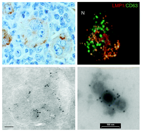 Figure 2. LMP1 localizes predominantly to the intraluminal vesicles of late endosomes in the cytoplasm. Immuno-histochemical staining of LMP1 in Hodgkins Disease lymphoid tissue, showing a characteristic heterogeneous expression of LMP1 in EBV containing Reed-Sternberg cells (upper left; nuclei in blue, LMP1 brown staining). Confocal staining of LMP1 (Alexa594) and CD63 (FITC) in LCLs, showing (upper right). Electron microscopy images on ultrathin cryosection of LCL, showing a late endosome containing ILVs labeled for LMP1 (lower left). (bar is 100nm) Immunogold labeling for LMP1 on purified exosomes isolated from LCL cultures by differential ultracentrifugation(lower right).