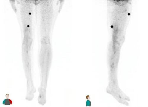 Figure 1 PET/CT image showing hyperdense lesions in the anterior and posterior right thigh. Views are anterior (left) and right lateral (right).