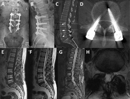 Figure 6 Typical cases of perioperative quadruple chemotherapy. X-ray 6 months postoperatively: no loosening of the internal fixation (A and B); CT 6 months postoperatively: formation of bony fusion between L4/5 (C and D); MRI 6 months postoperatively: no obvious abnormality (E–H).