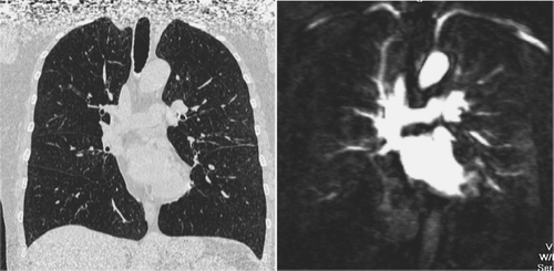 Figure 6 Coronal reformatted CT image and MR perfusion (10 mm MIP) of the patient suffering from severe emphysema showing a severe reduction of pulmonary perfusion and only marginal perfusion of the right basal and left subpleural regions.