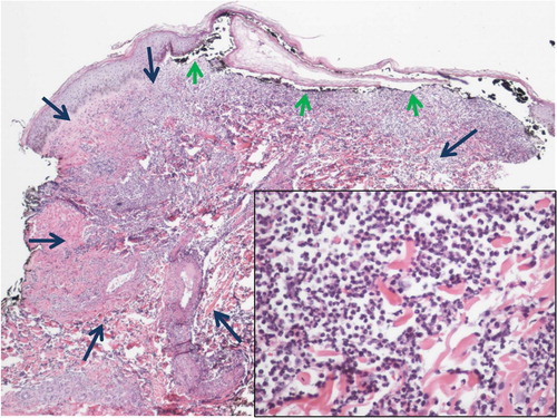 Fig. 5 Low power of right anterior proximal thigh skin biopsy showing changes of pyoderma gangrenosum. The center of the lesion (denoted by long blue arrows) shows a dense neutrophilic infiltrate with leukocytoclasia and dermolysis (inset: high power image of inflammatory infiltrate). Short green arrows point to undermining of epidermis by inflammatory infiltrate to the left and cutaneous ulceration to the center and right.