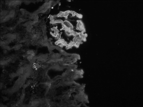 Figure 2. Immunofluorescence microscopy of renal biopsy showing characteristic linear deposition of IgG along the glomerular capillary loops.
