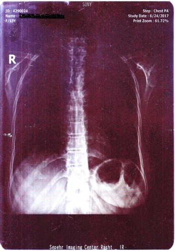 Figure 4 The chest X-ray showed no evidence of pulmonary involvement.