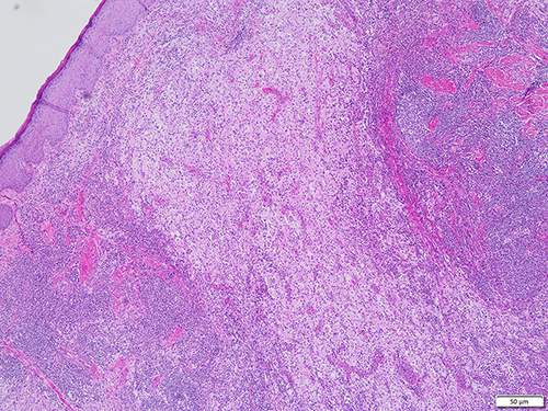 Figure 2 Lesions in the bright and dark areas of the dermis stimulate the lymph node structure (HE).