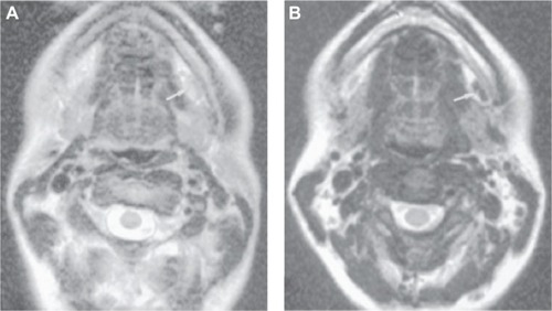 Figure 2 Axial MR imaging of the submandibular node of healthy volunteers after 36 h intravenous administration of Ferumoxtran-10 at a dose of 2.6 mg Fe/kg.Notes: (A) MR imaging without contrast agent and (B) enhanced contrast in node using Ferumoxtran-10 nanoparticles. Arrow in panel A indicates node which is difficult to visualize because it is nearly as intense as fat. Arrow in panel B shows excellent contrast between the enhanced left submandibular node and the subcutaneous fat. Republished with permission of AJNR Am J Neuroradiol, from Ferumoxtran-10, a superparamagnetic iron oxide as a magnetic resonance enhancement agent for imaging lymph nodes: a phase 2 dose study, Hudgins PA, Anzai Y, Morris MR, Lucas MA, 23(4):649–656, 2002, permission conveyed through Copyright Clearance Center, Inc.Citation32