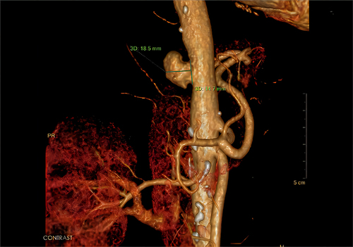 Figure 1 Three-dimensional computed tomography angiography shows the formation of a pseudoaneurysm in the aorta.