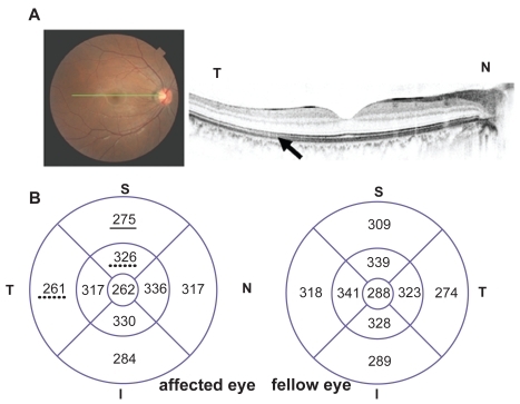 Figure 3 Case 1 Findings one year later. A) Optical coherence tomographic image of a 6-mm horizontal scan showing the loss of middle line and slightly decreased IS/OS line (arrow). B) Retinal volume map of the right and left eyes. The retina in right eye is thinner than that of the fellow eye by volume scan analysis. Values underlined = reduced by <10% and by dotted lines by <3%.
