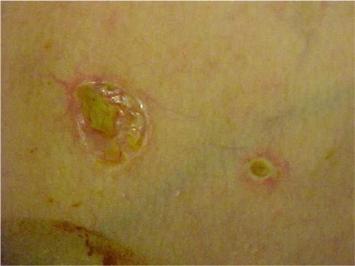 Figure 1 Initial skin lesions in Degos disease.