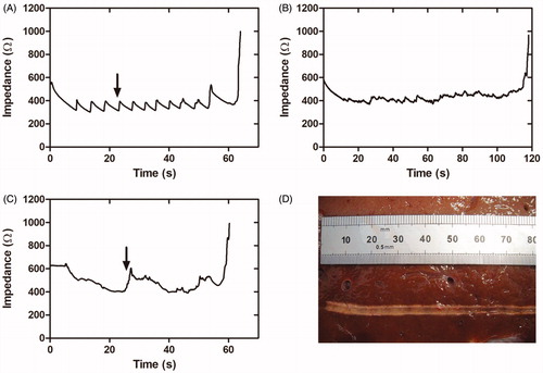 Figure 2. Results of the second set of ex vivo experiments. (A–C) Examples of impedance evolution (A). Small-amplitude sawtooth associated with slow and intermittent catheter pullback; (B and C). Smooth patterns associated with slow and continuous catheter pullback. (D) Thermal lesion created on bovine liver by slow and continuous pullback (impedance shown in B).