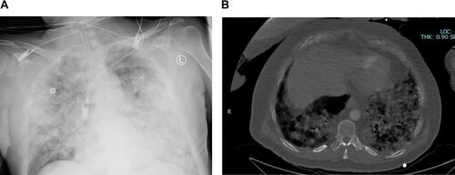 Figure 1 COVID-19 related pneumonia. (A) x-ray. (B) CT-scan.
