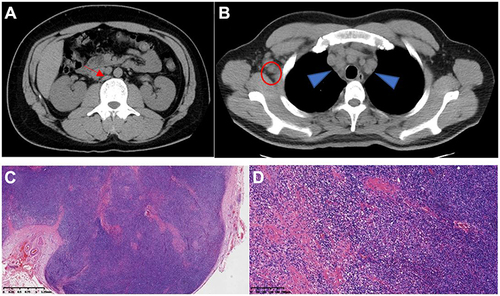 Figure 1 Computed tomography images. (A) swollen lymph nodes in the retroperitoneum (red arrow). (B) Swollen lymph node in right armpit (red circle). Swollen lymph nodes in the mediastinum (blue triangle). (C) Magnification ×20. Lymphoid follicular hyperplasia. (D) Magnification ×100 high endothelial venules with angiogenesis, infiltration of plasma cells and eosinophils, and localized fibrosis.