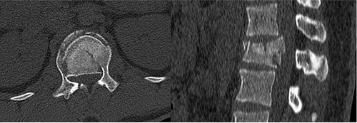 Figure 1 Axial and sagittal CT scan images: Subtype A4 injury. This 22-year-old man fell from a height. He had a neurological deficit (AIS D) and complained of severe back pain.