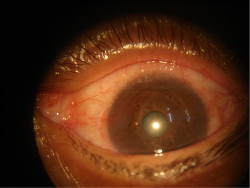 Figure 1C Appearance of the eye 5 months after the initial treatment cycle with topical 5-FU.