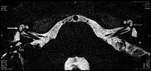 Figure 2. Magnetic resonance imaging of the temporal bone. Right side: EVA, interscalar septum (two small black arrows) pushed upwards resulting in enlarged scala vestibuli (white arrow). Left side: No enlargement of vestibular aqueduct with normal scala vestibuli (grey arrow) and normal located interscalar septum (one black small arrow) (with permission of Cochlear Implants International).