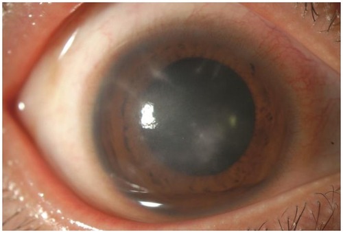 Figure 3 As the inflammation progressed, radial keratoneuritis was further observed at the eight, nine, ten, eleven, one, and three o’clock locations.