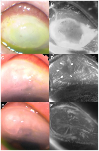 Figure 2 An 84-year-old man in the combination eye drop group. (A and B) Epithelial defects and profuse leakage are clearly visible. The leak point is unclear because of the profuse aqueous stream. (C and D) One month after cessation of treatment with the combination eye drops, the leakage (arrowheads) recurred due to a small point leak, and many microcysts were observed on the bleb wall. Treatment with combination eye drops was recommenced. (E and F) Thirty months after recommencement of treatment, the bleb had contracted slightly and the number of microcysts had decreased.