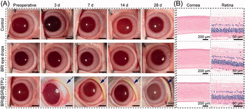 Figure 7. (A) Representative photos of ocular anterior segment preoperative and at day 3, 7, 14, and 28 after an administration of brimonidine (BRI) eye drops (0.15 wt%) or the BRI@SR@TPU implant which was marked by a blue arrow (row 3). In order to observe the sample more clearly, the rabbit eyelids were pulled open carefully when the photos were taken. (B) Representative photos of histological structures of cornea and retina stained with H&E after 28 days of observation.