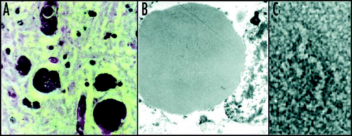 Figure 3 Mutant neuroserpin is retained within neurons as intracellular inclusions. These inclusions stain positive with PAS (A) and can be seen within the ER on electron microscopy (B). Electron microscopy of the isolated inclusions confirms that the mutant neuroserpin forms bead-like polymers identical to those of Z α1-antitrypsin (C). Figure reproduced with permission from Lomas et al.Citation97