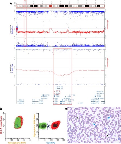 Figure 1 Molecular and clinical phenotype of PNH in CALR mutation-positive MPN.