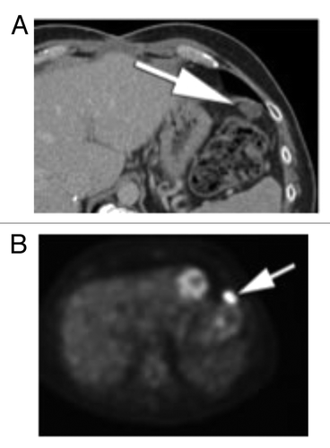 Figure 6. (A) Follow up after initial cytoreductive surgery. Contrast enhanced CT through the upper abdomen shows. progression of omental and peritoneal disease, with development of new oval soft tissue nodule in the left upper quadrant of the abdomen (arrow). (B) PET performed at the same time shows marked FDG avidity of the oval soft tissue nodules in the left upper quadrant of the abdomen (arrow), consistent with metastatic disease.