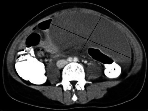 Figure 1 Computed tomographic appearance of the torsioned wandering spleen.