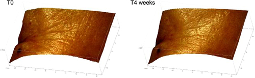 Figure 3 3D skin images obtained by Primos Pico Optical 3D Skin Measuring Device on a heathy volunteer before and after 4 months of treatment with KP1 serum. Courtesy of ISPE S.r.l.