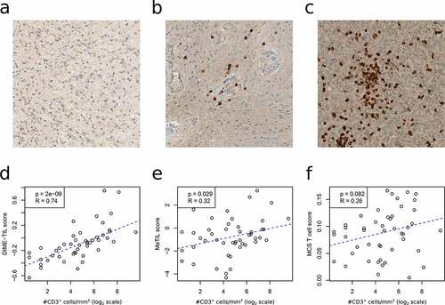 Figure 3. Immunohistological validation of methylation-based TIL estimates. Parallel immunohistological analyses for CD3 as well as methylation analyses were performed in a cohort of 47 brain tumors. Examples of tumors with low/absent CD3+ cells; a. anaplastic astrocytoma IDH-mutant, WHO grade III, intermediate CD3+ cells; b. rosette forming glioneuronal tumor, WHO grade I, and high numbers of CD3+ cells; c. glioblastoma IDH wild-type, WHO grade IV. Immunohistological counts of CD3+ cells are compared to DIME-TIL (d), MeTIL (e) and the sum of the T cells signatures analyzed by MethylCIBERSORT (f)