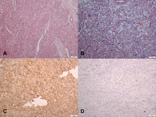 Figure 4 Pathological findings for case 3: (A) (H&E×100), (B) (H&E×200),Microscopically, tumor cells are large and polygonal, with abundant and eosinophilic cytoplasm. The nuclei were round or oval in shape, varied in size, and some cells were binucleate. The nuclear membrane was thickened, the nucleus was pale stained, the nucleolus was obvious, atypia was not obvious, and mitotic figures were seen. The tumor tissue is poorly defined from normal tissue and shows infiltrative growth. (C) positive stain for AFP(×100). (D) negative stain for Hepatocyte-paraffin 1(×100). Besides, we got immunohistochemical analysis as follows: PAX8(-), P53(-), P16(-), ER(-), PR(-).