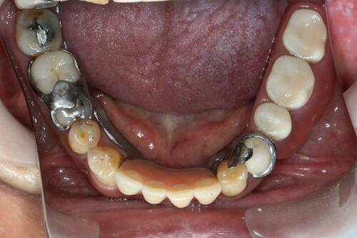 Figure 20 Mandibular denture 10 years after delivery (flipped mirror image).